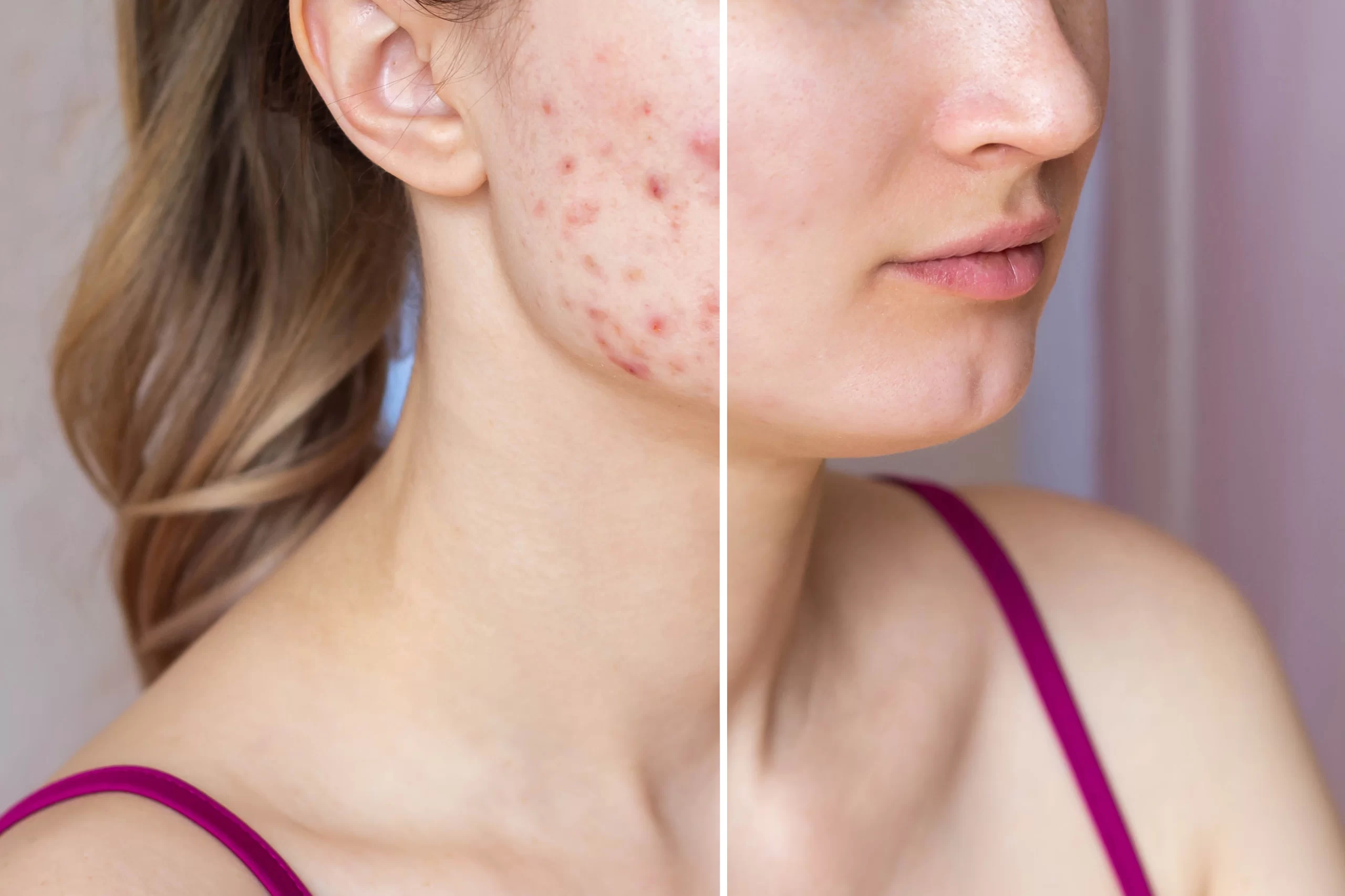 Charcoal powder for skin acne