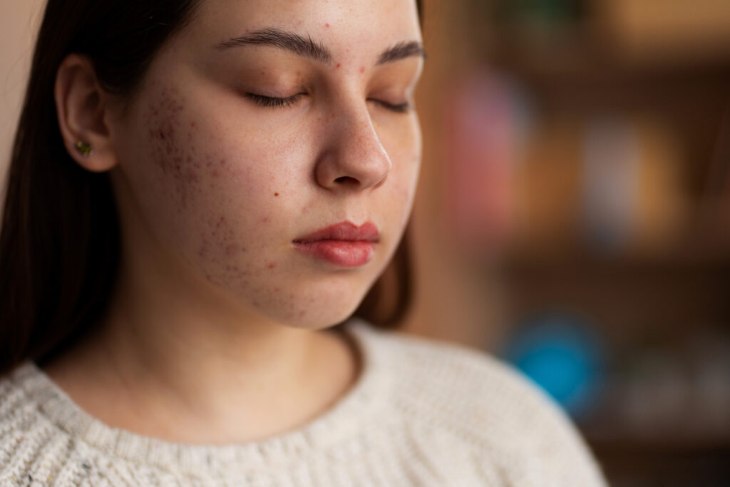 Reduces Hyperpigmentation