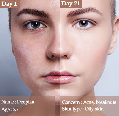 oily-skin